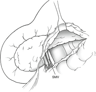 Major Abdominal Veins | Plastic Surgery Key