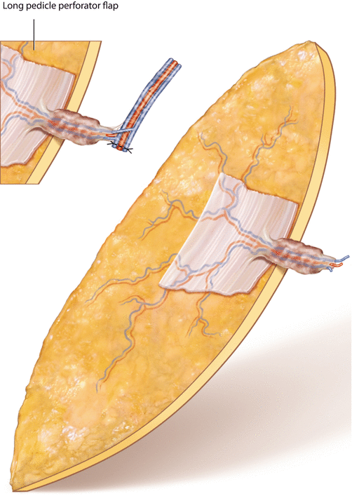Anterolateral Thigh Perforator Flap Plastic Surgery Key