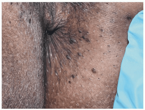 Dark-colored Lesions: Brown, Blue, Gray, or Black Disorders | Plastic Surgery Key Dark-colored Lesions: Brown, Blue, Gray, or Black Disorders | Plastic Surgery Key