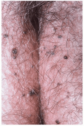 Dark-colored Lesions: Brown, Blue, Gray, or Black Disorders | Plastic Surgery Key Dark-colored Lesions: Brown, Blue, Gray, or Black Disorders | Plastic Surgery Key