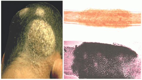 Fungal And Algal Cutaneous Infections Plastic Surgery Key Fungal And Algal Cutaneous Infections Plastic Surgery Key
