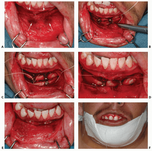 Mandibular Vestibular Approach | Pocket Dentistry