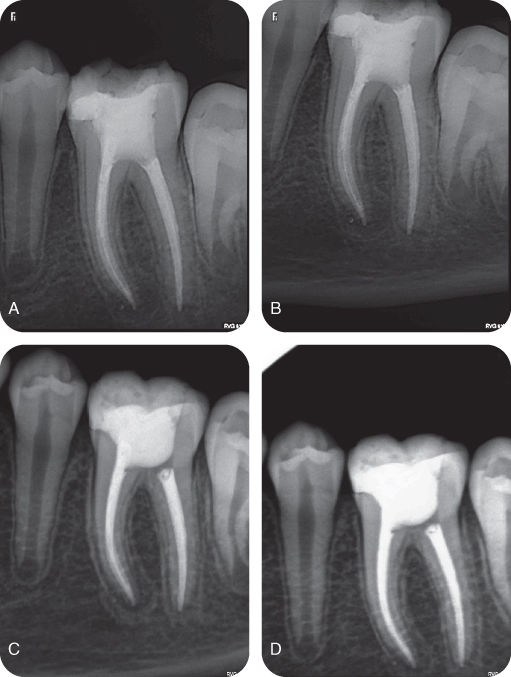 Nonsurgical Root Canal Treatment Case VIII Mandibular Molar Pocket