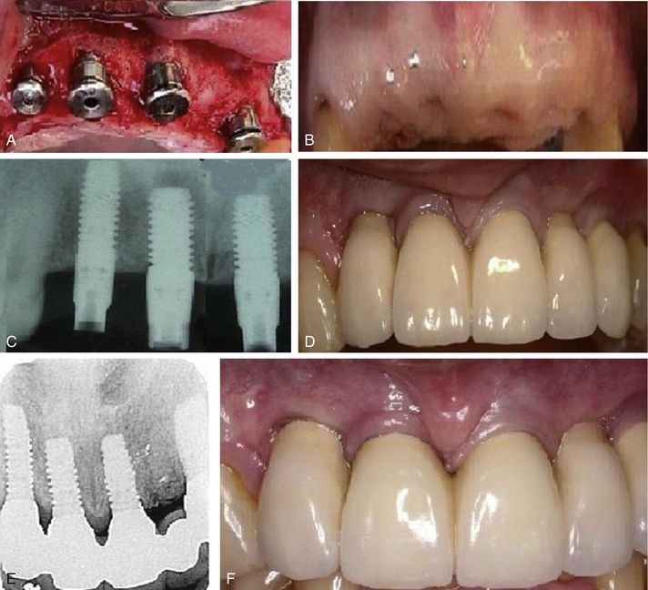 Complications Associated With Immediate Implant Placement Pocket