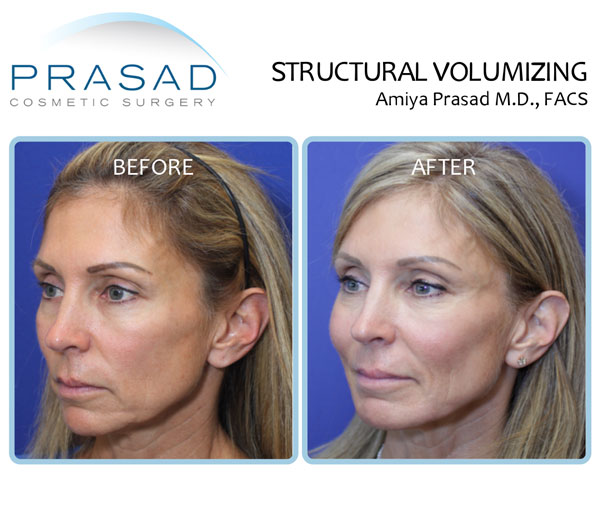 Successful lip line treatment is multimodal. The Best Treatments For Lines Around The Mouth Dr Prasad S Blog