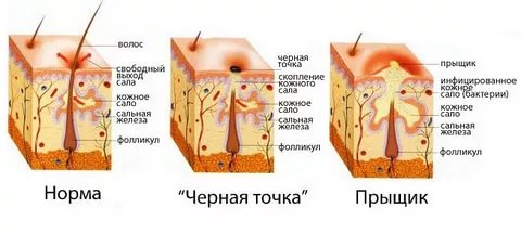 Отвечаем на щекотливый вопрос – что делать, если на ореоле появился прыщик? На ореоле соска прыщ На груди возле соска прыщ