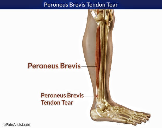 Peroneus Brevis Muscle PT Master Guide