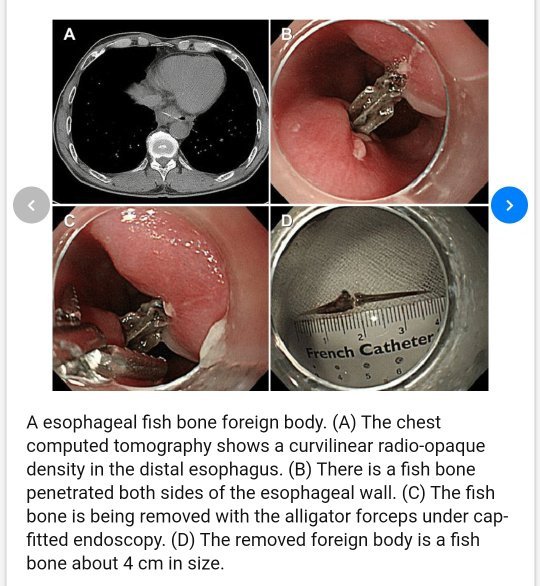 Padahal, ada beberapa cara yang bisa diusahakan untuk menghilangkan tulang ikan yang tersangkut di tenggorokan. Apakah Menelan Duri Ikan Berbahaya Jika Iya Apa Tandanya Saat Kita Sudah Harus Ke Dokter Quora