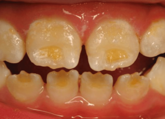 Apakah hipoplasia email bisa hilang? - Quora