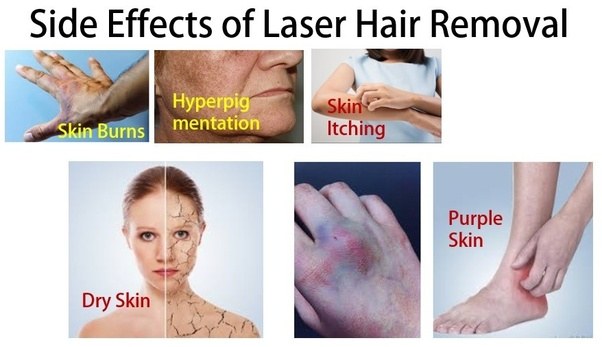 The most common side effects of laser hair removal treatment are: What are laser hair removal benefits, side effects, and ...