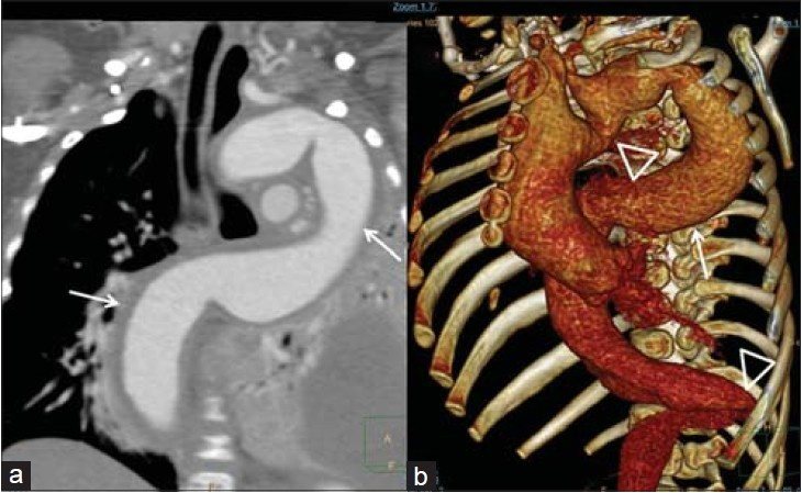 During our investigation of the tortuous internal carotid artery in the presence of atherosclerosis, we noted a 44% incidence of abdominal aortic aneurysm. What Can I Do If My Aorta Is Tortuous And Calcified Quora