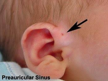Other times this condition is caused by a sinus infection. What Kind Of Infection In Preauricular Sinus Causes Thick Yellow Fluid To Accumulate Near The Ears Is It Curable Or Draining It Is The Only Option Quora