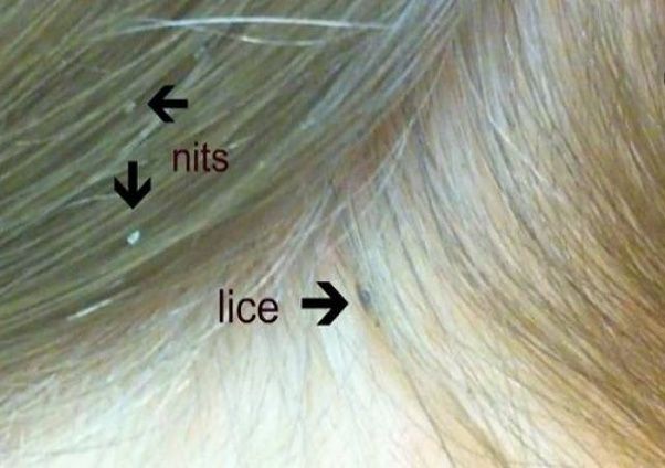 Check spelling or type a new query. What do lice and nits look like in the hair? - Quora