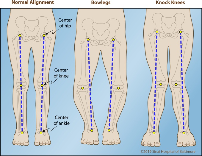 Apakah bentuk kaki O atau X bisa disembuhkan? - Quora