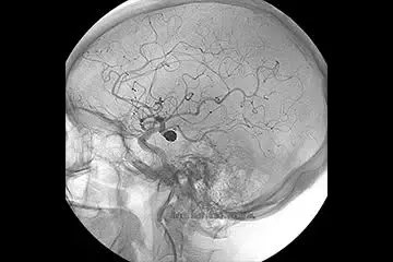 Bagaimana aneurisma otak dan stroke ditangani? - Quora