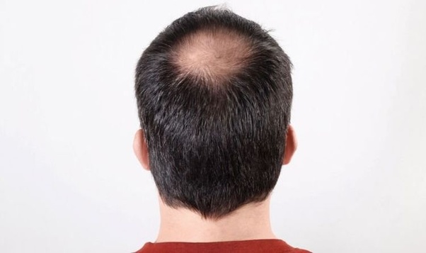 How To Prevent Hair Fall For Male Quora At What Age Do Most Men With Male Pattern Baldness Start Balding Quora Swiss Chard Is A Leafy Green Veggie With Colorful