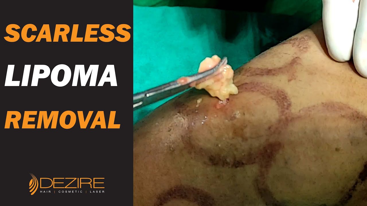 Apa itu lipoma? Seberapa berbahaya itu? Apakah bisa dengan mudah diobati? -  Quora
