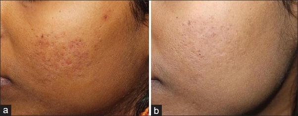 If acne scars are bothering you, there are ways to get rid them. What is the best way to get rid of this indented