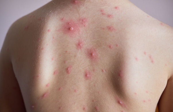 Per the pi, mmr, varicella, zoster, and mmrv should . Can Varicella vaccine prevent the spread of Chicken Pox after the disease has already entered