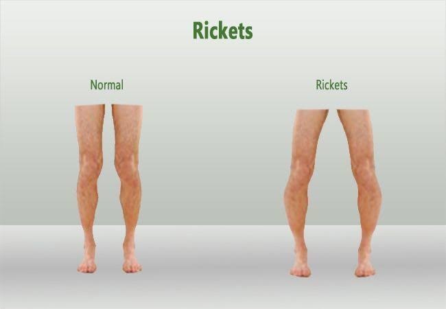 Penyakit apa yang disebabkan oleh kekurangan fosfor? - Quora