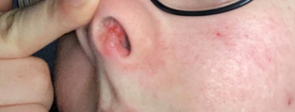 The mucosa is a very wet layer that helps protect the inside of your nose and sinuses and humidifies the air you breathe. Blisters Inside Nose Online 54 Off Sportsregras Com