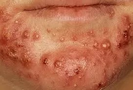 In oral herpes, most blisters appear on the lips or mouth. How To Distinguish Acne And Herpes Quora