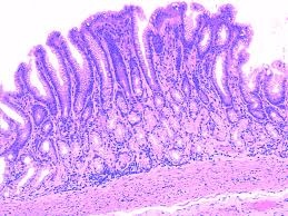 If you have been diagnosed with adenocarcinoma cancer, you have a cancer that developed in one of the glands that lines the inside of your organs. What are the names of gastric glands? - Quora