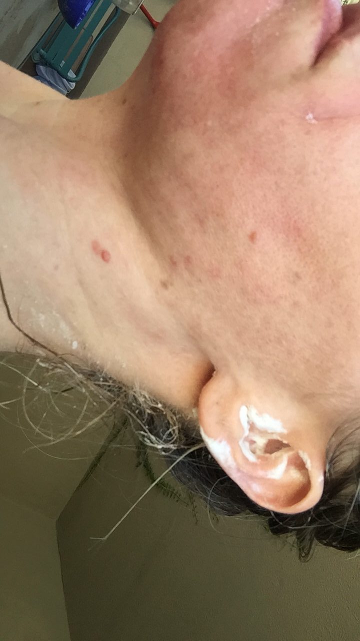 Mar 14, 2019 · white spots on skin usually occur in the form of small dots or as patches. A Worm Is Crawling Under My Skin Into My Earlobe Ask Answer And Discuss Medical Questions