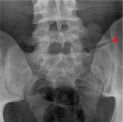 Symptoms related to ligamentum flavum buckling usually only occur when the spine is straight. Thoracic and Lumbar Spine | Radiology Key