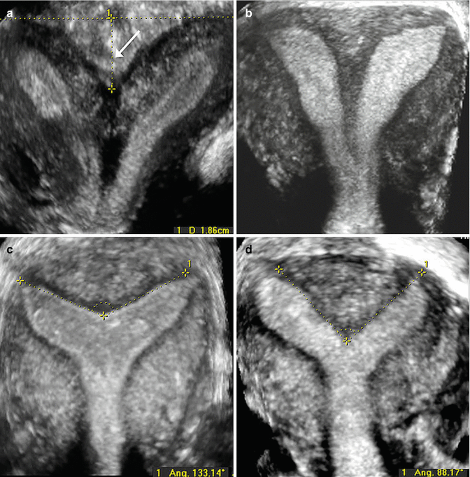 Congenital Uterine Anomalies Radiology Key