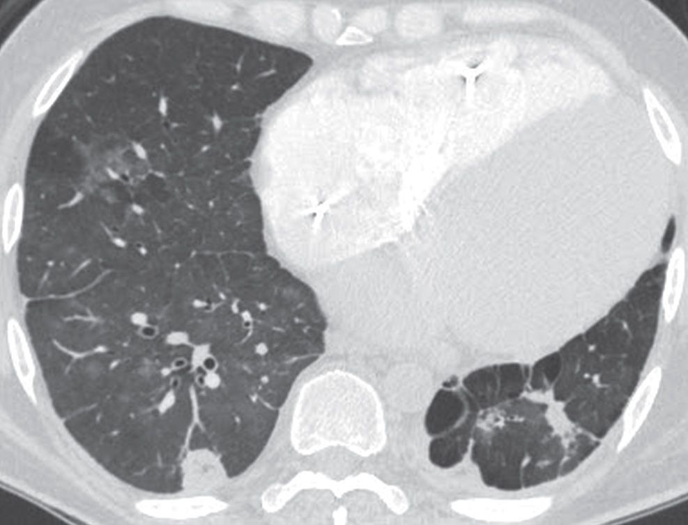 Pulmonary Vasculature Disease | Radiology Key