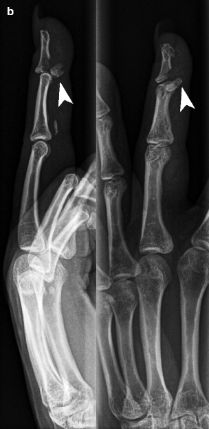Imaging of Upper Extremity | Radiology Key