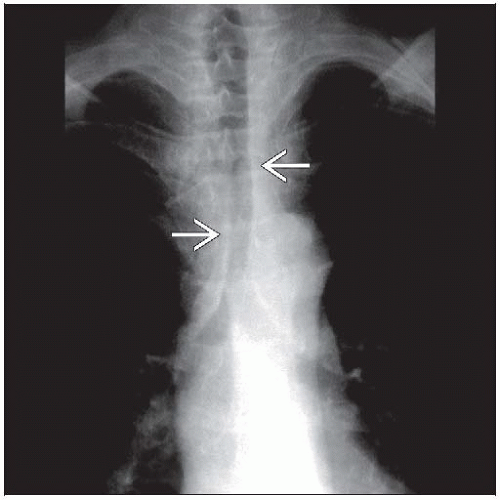 Coxa valga is a deformity of the hip where the angle formed between the head and neck of the femur and its shaft is increased, usually above 135 degrees. Relapsing Polychondritis | Radiology Key