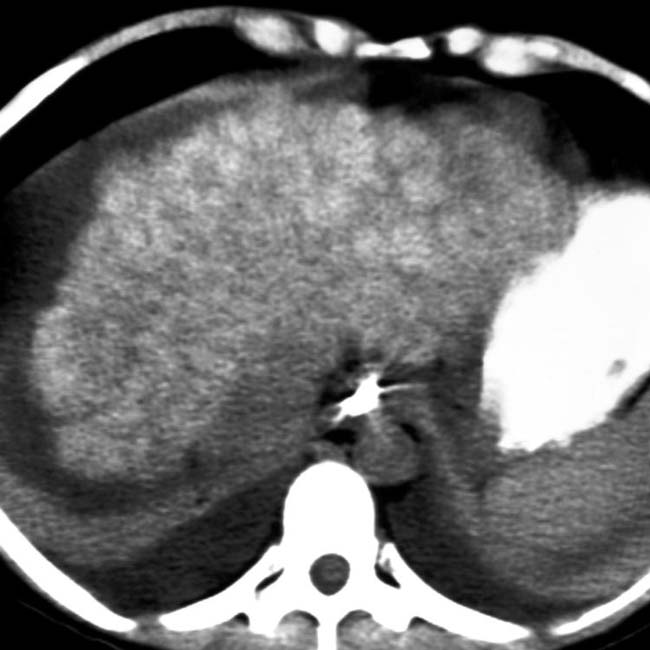 Wilson Disease Radiology Key