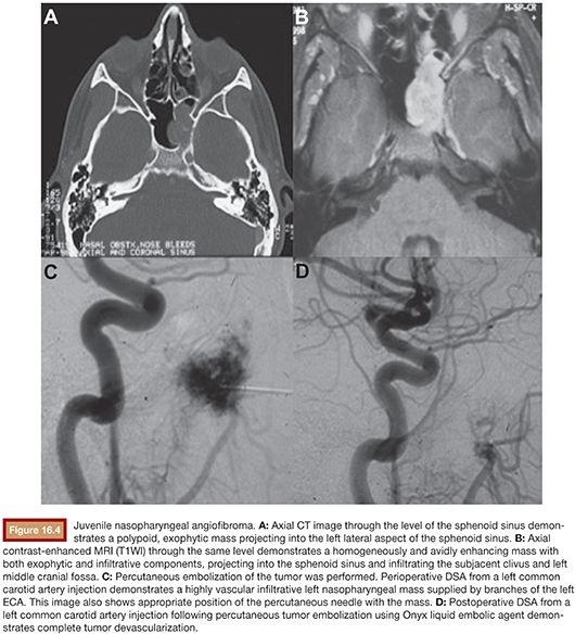 Vascular Tumors Radiology Key