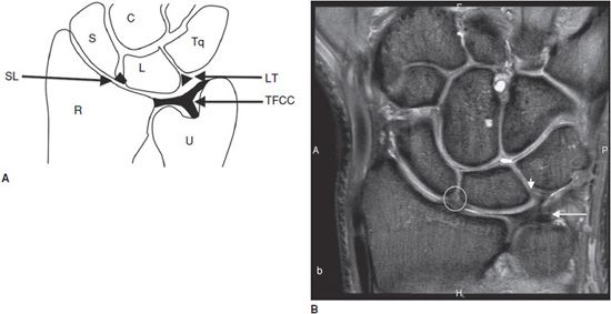 Click here to get an answer to your question ✍️.draw a labelled diagram of the transverse section of a long bone. Wrist MRI | Radiology Key