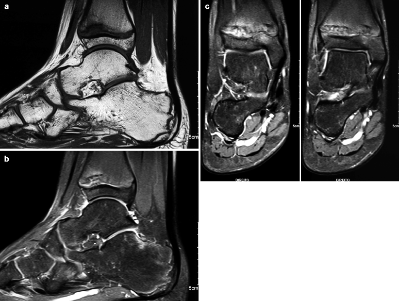 SportsRelated Musculoskeletal Lesions in Pediatric Patients Radiology Key