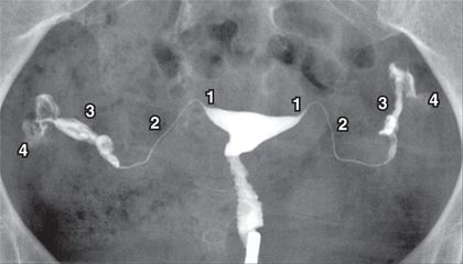 Female Genital II (Ovary, Fallopian Tube, Vagina, Vulva) | Radiology Key