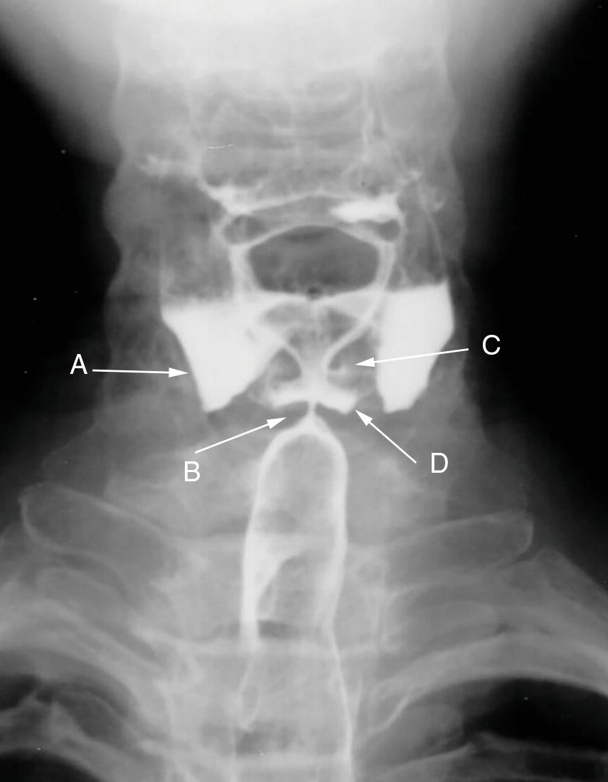 Pharynx and Esophagus Radiology Key