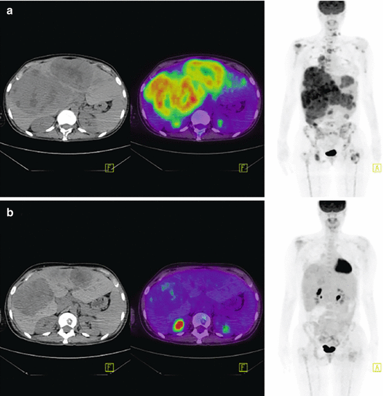 Role of PET/CT in Melanoma Radiology Key