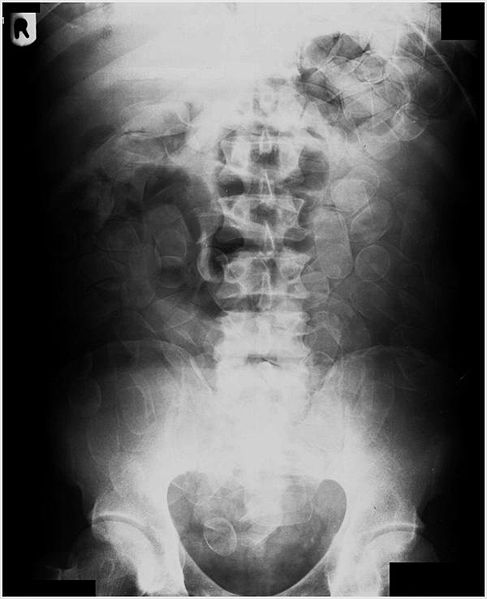 Body Packer - Cocaine packets throughout the colon - radRounds ...