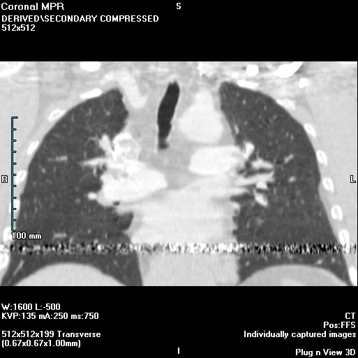 Xray Tube Arcing Artefact radRounds Radiology Network