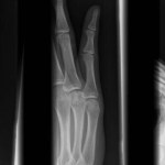 Volar Plate Fracture