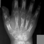 Sudeck’s Atrophy (Reflex Sympathetic Dystrophy Syndrome)