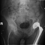 Hardware Complication – Dislocated left hip replacement hardware