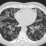 Crazy Paving on Chest CT