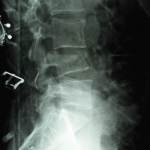 Lumbar Compression Fracture (X-Ray)
