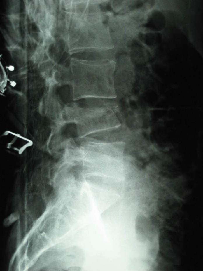 Lumbar Compression Fracture (XRay) radRounds Radiology Network