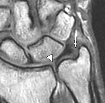 Tfcc Complex Anatomy - Triangular Fibrocartilage Tear - Radsource