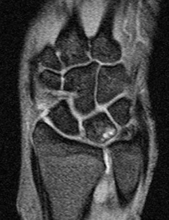 The shoulder of a road is an emergency stopping line next to the travel lanes. Ulnocarpal Abutment - Radsource